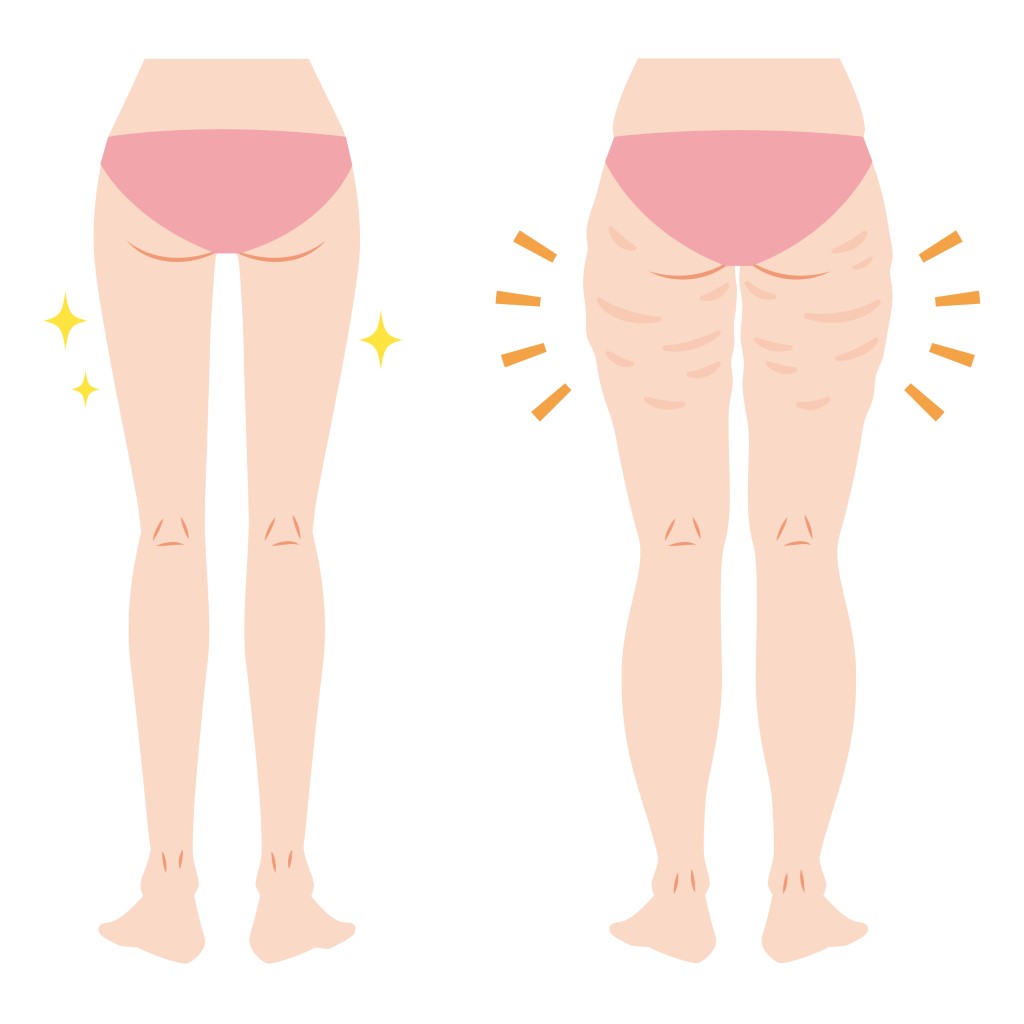 太もものセルライトエステで理想の美脚へ